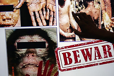 EEUU y Europa registran casos de la viruela del mono Qué se sabe de la enfermedad Cuán peligrosa es Hay tratamiento