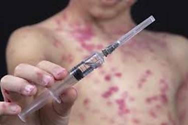 Minsa informa que han detectado 5 nuevos casos de viruela símica