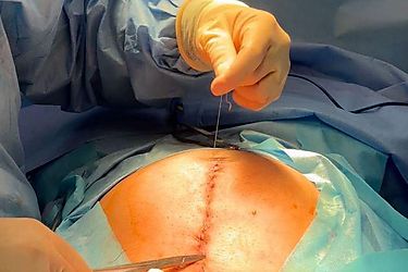 Realizan en la CSS la primera cirugía intrauterina por espina bífida en Panamá