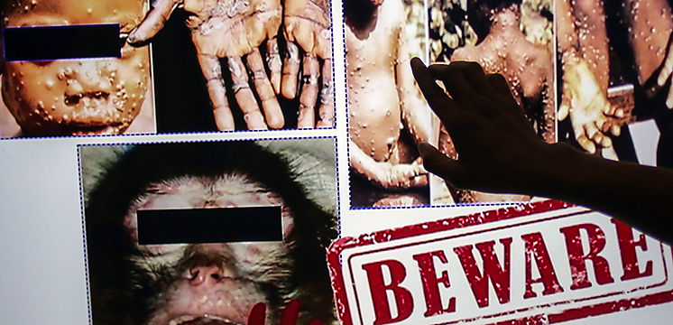 EEUU y Europa registran casos de la viruela del mono Qué se sabe de la enfermedad Cuán peligrosa es Hay tratamiento
